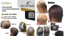 Hair Loss Treatment - Permanent Solution tại California